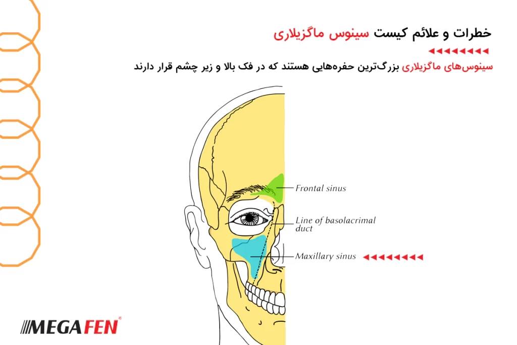 خطرات و علائم کیست سینوس ماگزیلاری