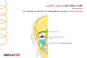 خطرات و علائم کیست سینوس ماگزیلاری