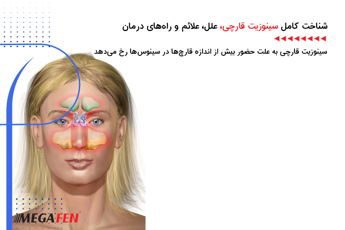 شناخت کامل سینوزیت قارچی: علل، علائم و راه‌های درمان