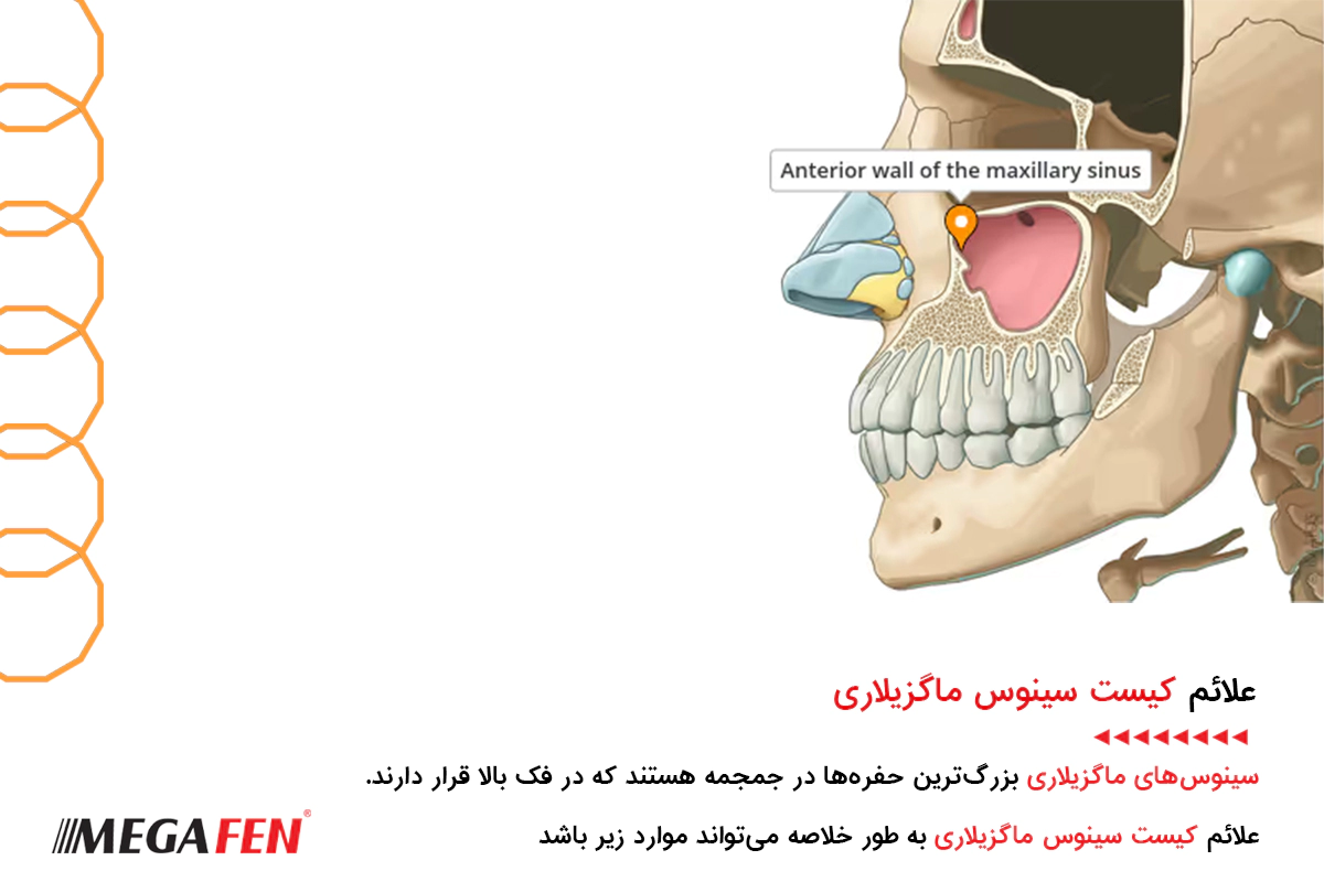 علائم کیست سینوس ماگزیلاری